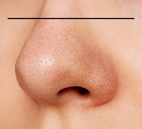The Unseen Factor: How Nasal Skin Thickness Shapes Your Rhinoplasty Results